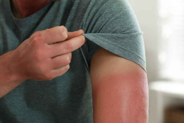 Ayvalık Güneş Yanığı: Sağlık Kabinimizle Doğal Tedavi